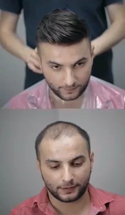 Trasformazione capelli con toupet per uomo